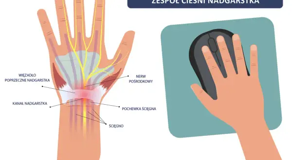 Ilustracja pokazuje anatomię dłoni z zaznaczonym kanałem nadgarstka, nerwem pośrodkowym i ścięgnami, wyjaśniając zespół cieśni nadgarstka. Dłoń trzyma myszkę komputerową.