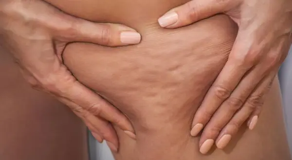 Hände greifen in die Haut, um Cellulite zu zeigen. Viele fragen sich, ob und wie geht cellulite wieder weg.