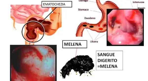 Illustrazione medica che mostra ematochezia e melena, sintomi di sanguinamento gastrointestinale, inclusa la presenza di sangue nelle feci.