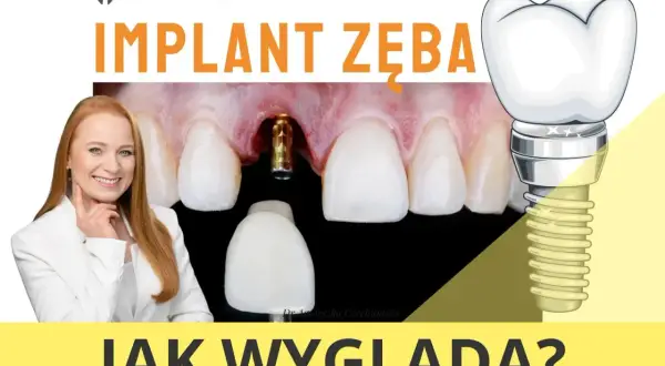 Zobacz, jak wygląda implant zęba: złoty element wkręcony w dziąsło i jego schematyczny rysunek z koroną.