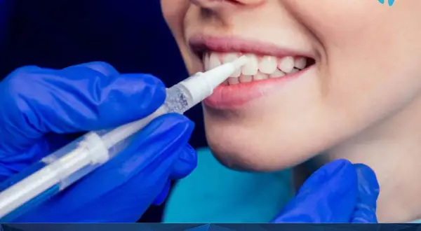 Profesjonalne lakierowanie zębów u dorosłych. Dentysta aplikuje środek wybielający na zęby pacjentki.