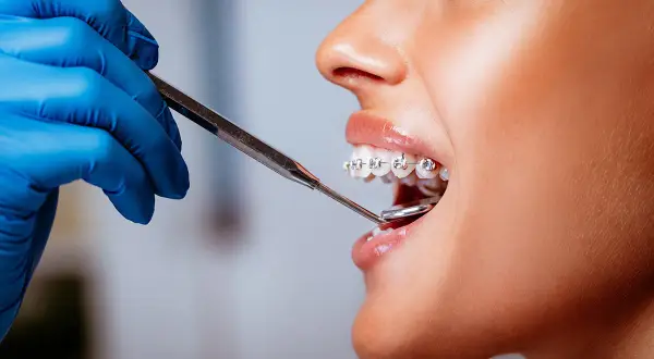Primo piano di una bocca con apparecchio, mentre un dentista con guanto blu esamina i denti per raddrizzare i denti.
