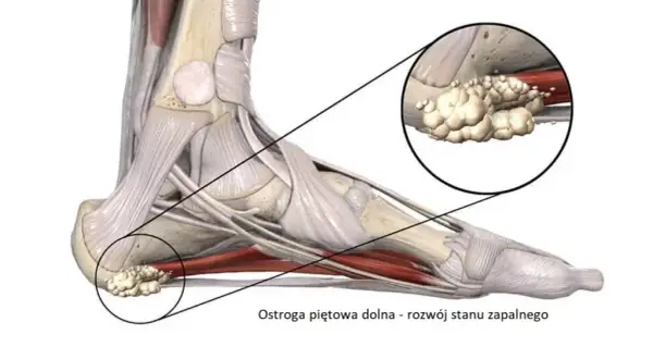 Ostroga piętowa: do jakiego lekarza i jak leczyć?