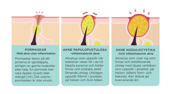 Illustrationer visar olika typer av akne, från pormaskar till svårare inflammationer. Lär dig hur man får bort finnar och vad som orsakar dem.