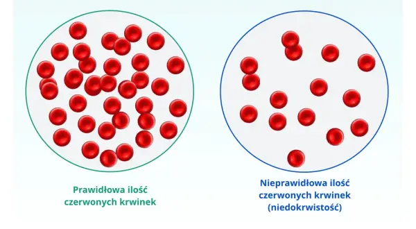 Porównanie prawidłowej i nieprawidłowej ilości czerwonych krwinek, czyli elementów morfotycznych krwi, w kontekście niedokrwistości.