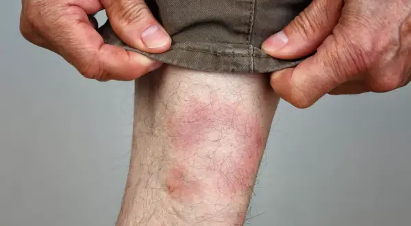 Rote, gereizte Haut am Bein, die auf einen Zeckenbiss hindeutet. Hände ziehen die Hose hoch.