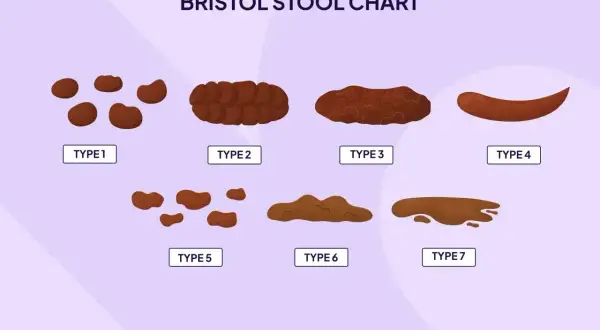 Wykres Bristolskiej Skali Stolca pokazuje 7 typów, od twardych grudek (typ 1) po płynne (typ 7). Typ 6 i 7 mogą wskazywać, ile trwa biegunka.