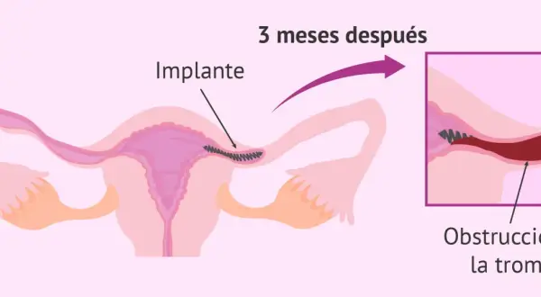 Ilustración muestra un implante en la trompa de Falopio, que causa obstrucción. Esto es un método de ligadura de trompas.