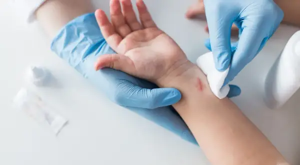 Lekarz w niebieskich rękawiczkach opatruje ranę na nadgarstku dziecka, która może być objawem ziarniny zapalnej.
