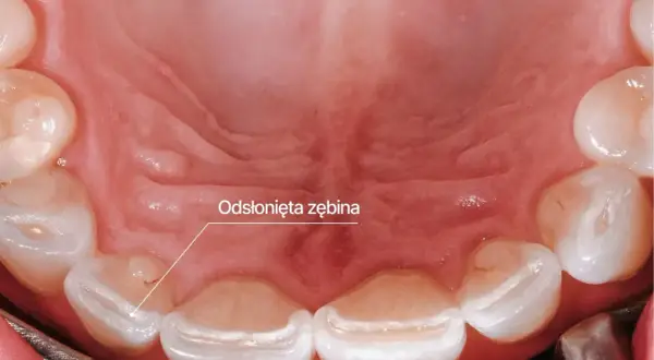 Widoczne odsłonięte zęby, jeden z objawów bruksizmu. Zęby są starte, z widocznymi ubytkami szkliwa.