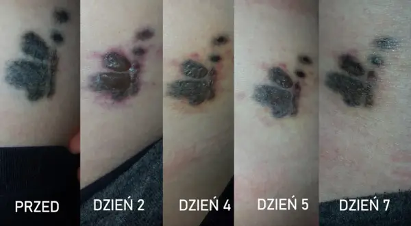 Postęp usuwania tatuażu łapy: od świeżej rany po gojenie. Dzień 2, 4, 5, 7.