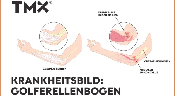 Vergleich gesunder und entzündeter Sehnen am Ellenbogen, der Golferellenbogen-Symptome zeigt. Kleine Risse in den Sehnen sind sichtbar.