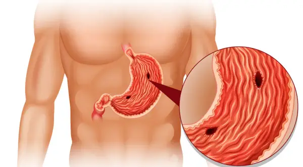 Anatomia żołądka z widocznymi wrzodami. Powiększony fragment ukazuje głębokie ubytki w błonie śluzowej.