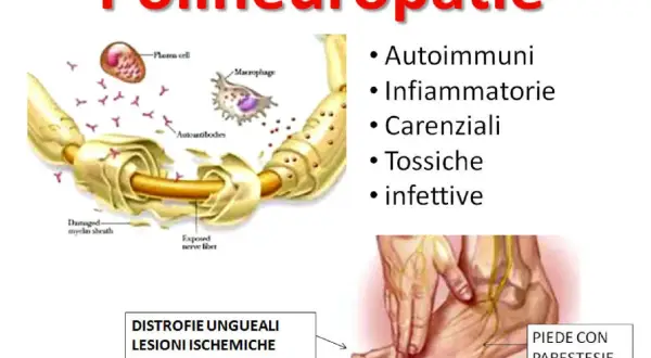 Illustrazione delle polineuropatie: cause autoimmuni, infiammatorie, carenziali, tossiche, infettive. Danno alla guaina mielinica e al nervo. Piede con parestesie.