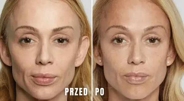 Przed i po zabiegu z użyciem kwasu polimlekowego stymulatora. Skóra twarzy jest gładsza, bardziej napięta i odmłodzona.