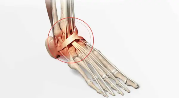 Illustration anatomique du pied montrant les conséquences d'une fracture mal soignée, avec une zone rouge entourant les tendons et ligaments de la cheville.