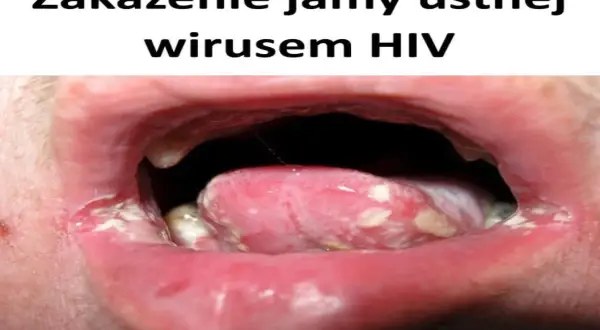 Zakażenie jamy ustnej wirusem HIV objawia się m.in. nalotem na języku i pleśniawkami.