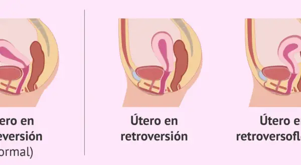 Ilustración comparativa de la posición del útero: anteversión (normal), útero en retroversión y útero en retroversoflexión.