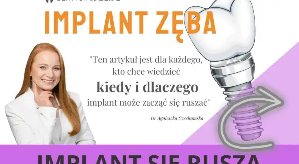 Uśmiechnięta kobieta i grafika implantu zęba. Artykuł wyjaśnia, kiedy i dlaczego ruszający się implant zęba może być problemem.