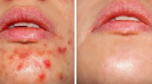Przed i po: kwas salicylowy peeling skutecznie redukuje wypryski i zaczerwienienia wokół ust, przywracając gładkość skóry.