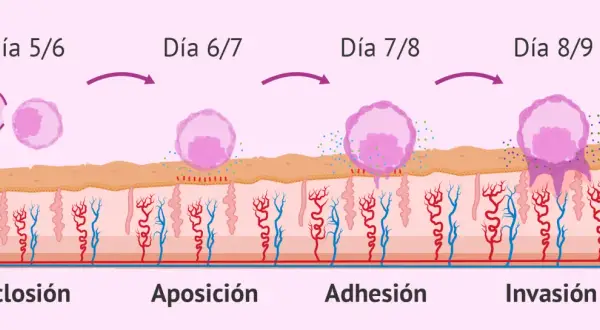 Ilustración de la implantación embrionaria: eclosión, aposición, adhesión e invasión del blastocisto en el endometrio.