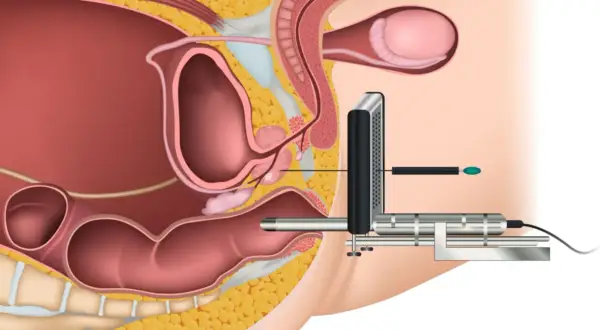 Darstellung einer MRT-gestützten Biopsie der Prostata. Ein Gerät wird in den Enddarm eingeführt, um die Prostata zu erreichen.