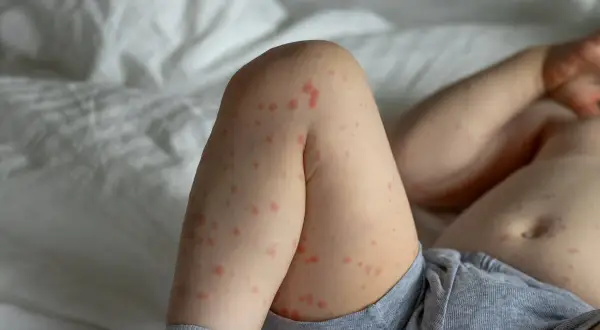 Piernas de un bebé con erupción cutánea roja, indicativo de roseola bebe.