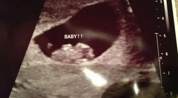 Ecografía temprana con la palabra "BABY!!" escrita. La posición del saco gestacional podría ser analizada con el método Ramzi.