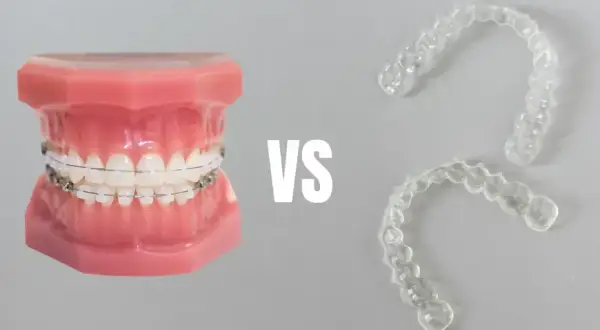 Aparat na zęby dla dzieci: Jak wygląda? Ruchomy vs. stały