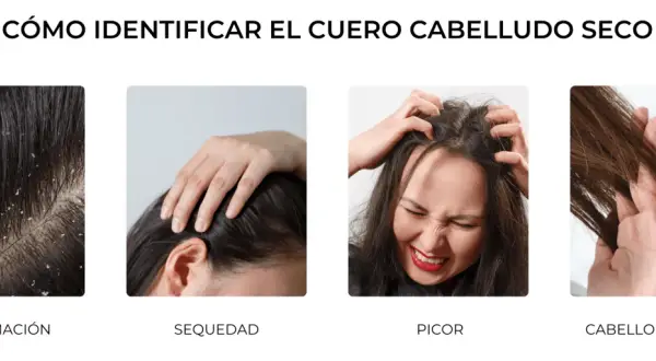 Cuatro imágenes muestran síntomas de cuero cabelludo seco: descamación, sequedad, picor y cabello sin brillo.