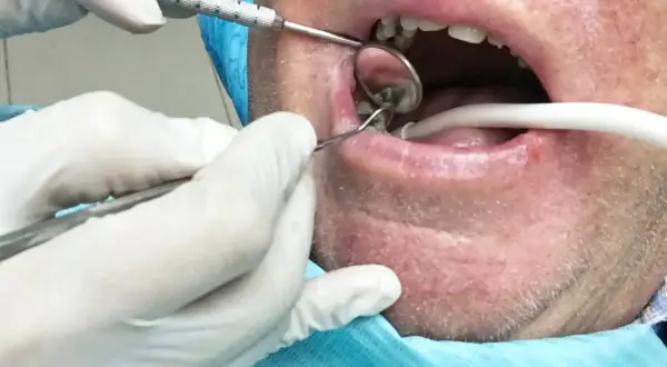 Dentysta wykonuje usuwanie korzenia zęba z ropą. Widoczne narzędzia stomatologiczne i lusterko.