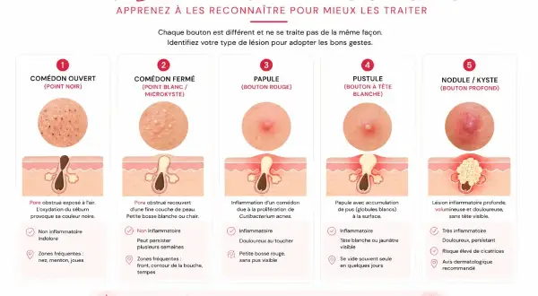 Infographie expliquant les 5 types de bouton visage : comédon, papule, pustule, nodule/kyste. Chaque type est illustré et décrit.