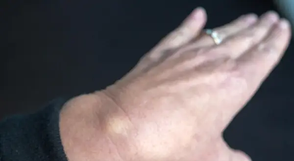 Ein kleiner, gelblicher Schleimbeutel am Handgelenk einer Person mit einem Ring.