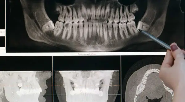 Radiographie dentaire montrant une dent de sagesse impactée, indiquant la nécessité d'une extraction.