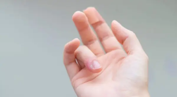 Mano con dito arrossato e gonfio, segno di infiammazione dita mano.