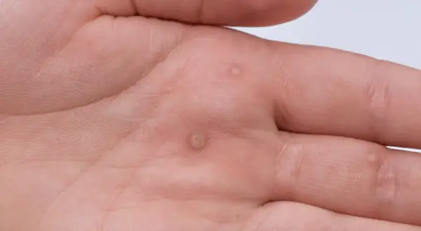 Dłoń mężczyzny z kilkoma brodawkami, które mogą być objawem wirusa HPV.