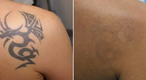 Przed i po zabiegu laserem pikosekundowym: widoczny tatuaż smoka na ramieniu, a po prawej jego wyraźne rozjaśnienie.