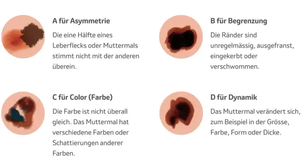 Hautveränderungen: Asymmetrie, unregelmässige Ränder, Farbwechsel und Dynamik sind Anzeichen für schwarzen Hautkrebs (Vorstufe).