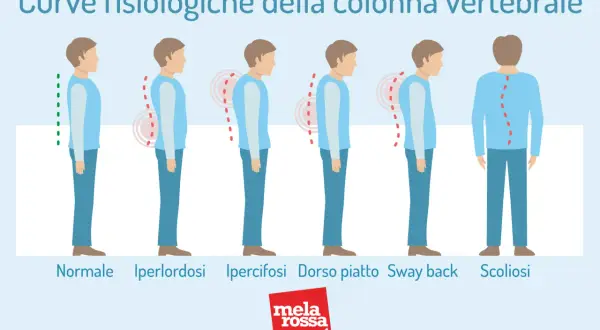 Illustrazione mostra posture della colonna vertebrale: normale, iperlordosi, ipercifosi, dorso piatto, sway back e scoliosi. La scoliosi sinistro-convessa può causare invalidità.