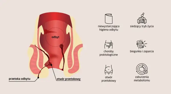 Schemat anatomiczny przedstawiający przetokę odbytu i jej potencjalne przyczyny, takie jak choroby proktologiczne czy zaburzenia metabolizmu.
