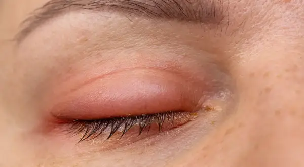Ojos hinchados y enrojecidos, con secreción amarillenta en las pestañas. Parece que alguien lloró mucho o tiene una infección.