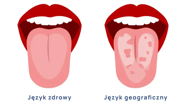 Dwa języki: zdrowy, różowy i gładki, obok języka geograficznego z plamami.