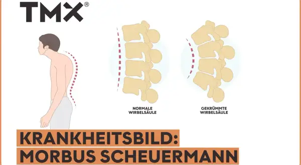 Vergleich einer normalen und gekrümmten Wirbelsäule, die das Krankheitsbild Morbus Scheuermann im Endstadium illustriert.