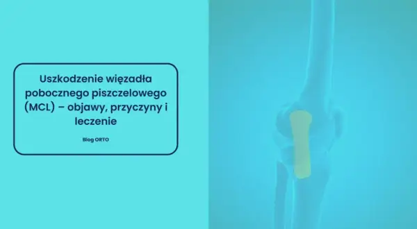 Ilustracja przedstawia uszkodzenie więzadła pobocznego piszczelowego (MCL) w stawie kolanowym.