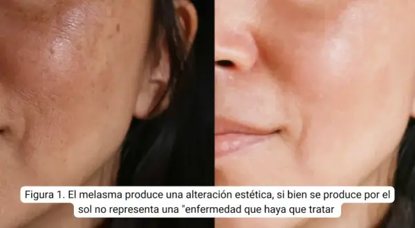 Comparativa de piel con melasma y piel tratada. Buscando amchafibrin para manchas opiniones, se observa mejora.