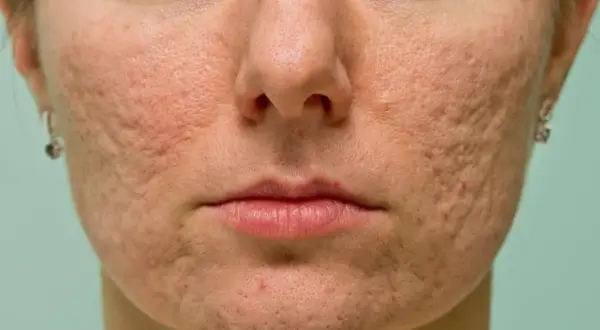 Pasta do zębów na pryszcze? Dermatolog radzi, co naprawdę działa!