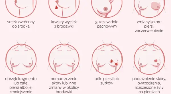 Ilustracja pokazuje objawy, które mogą wskazywać na nowotwór złośliwy sutka: zmiany brodawki, guzek, obrzęk, zaczerwienienie, ból.