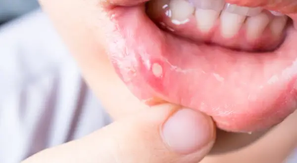 Nahaufnahme einer Lippe mit einem weißen, wunden Fleck. Ein Finger berührt die betroffene Stelle, die auf wunden im mund hausmittel hinweist.