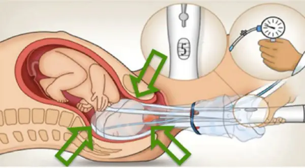 Illustration d'un bébé dans l'utérus, avec une ventouse d'accouchement appliquée sur sa tête. Un manomètre indique la pression.