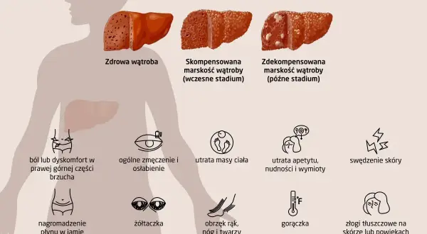 Marskość wątroby: objawy, stadia i prognozy dotyczące tego, ile się żyje. Ilustracja pokazuje zdrową i uszkodzoną wątrobę oraz symptomy choroby.